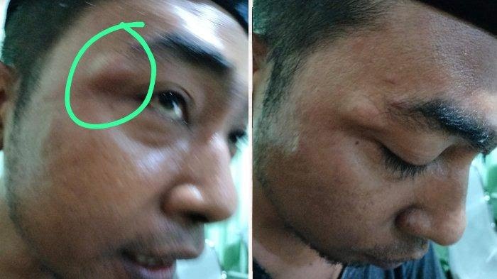 Kondisi Azif Saat Usai Dipukul Oleh Oknum Aparat Kepolisian Di Pamekasan.