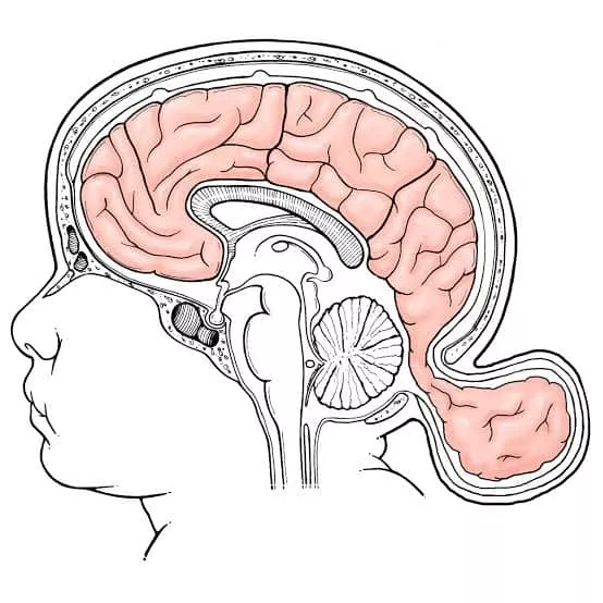 Waspada Encephalocele, Ini Penyebab Dan Gejalanya